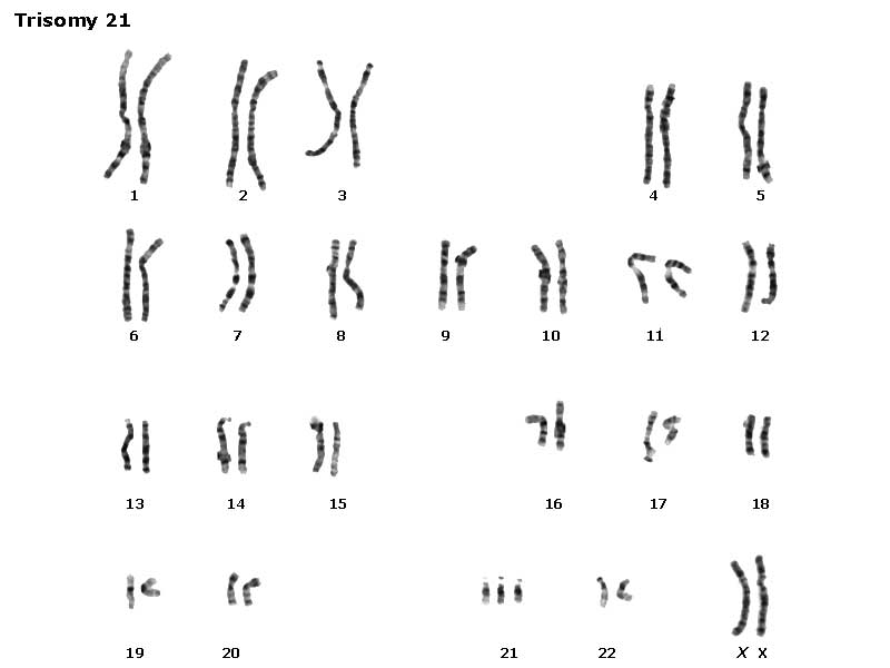 Trisomy 9 Karyotype